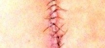 scar of my back surgery